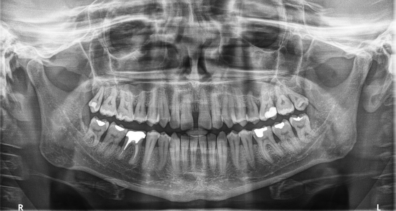 تجزیه و تحلیل Airway